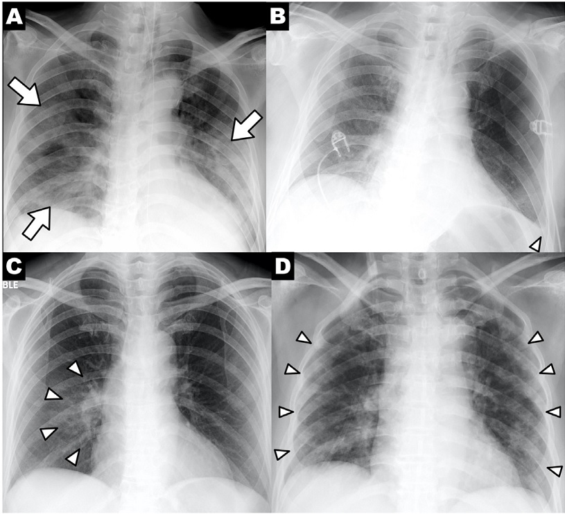 Range of changes on plain film Wong et al Rad 2020